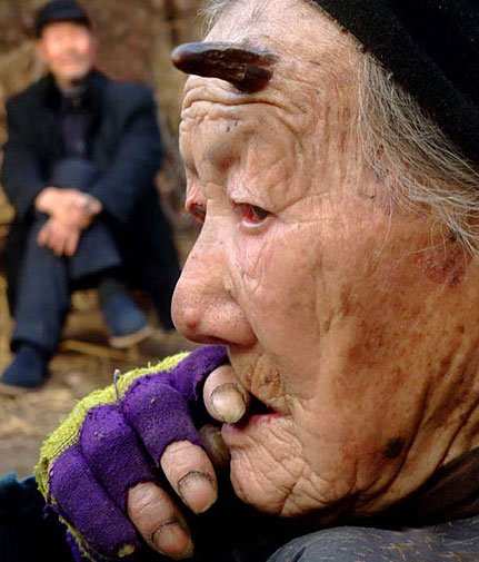 У 101-летней китаянки вырос настоящий рог! (ФОТО)